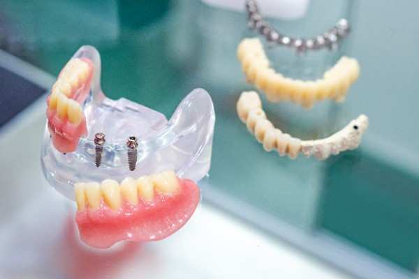 Smilo Dental Implants