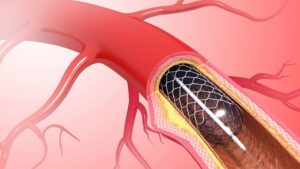North America Balloon Catheter Market