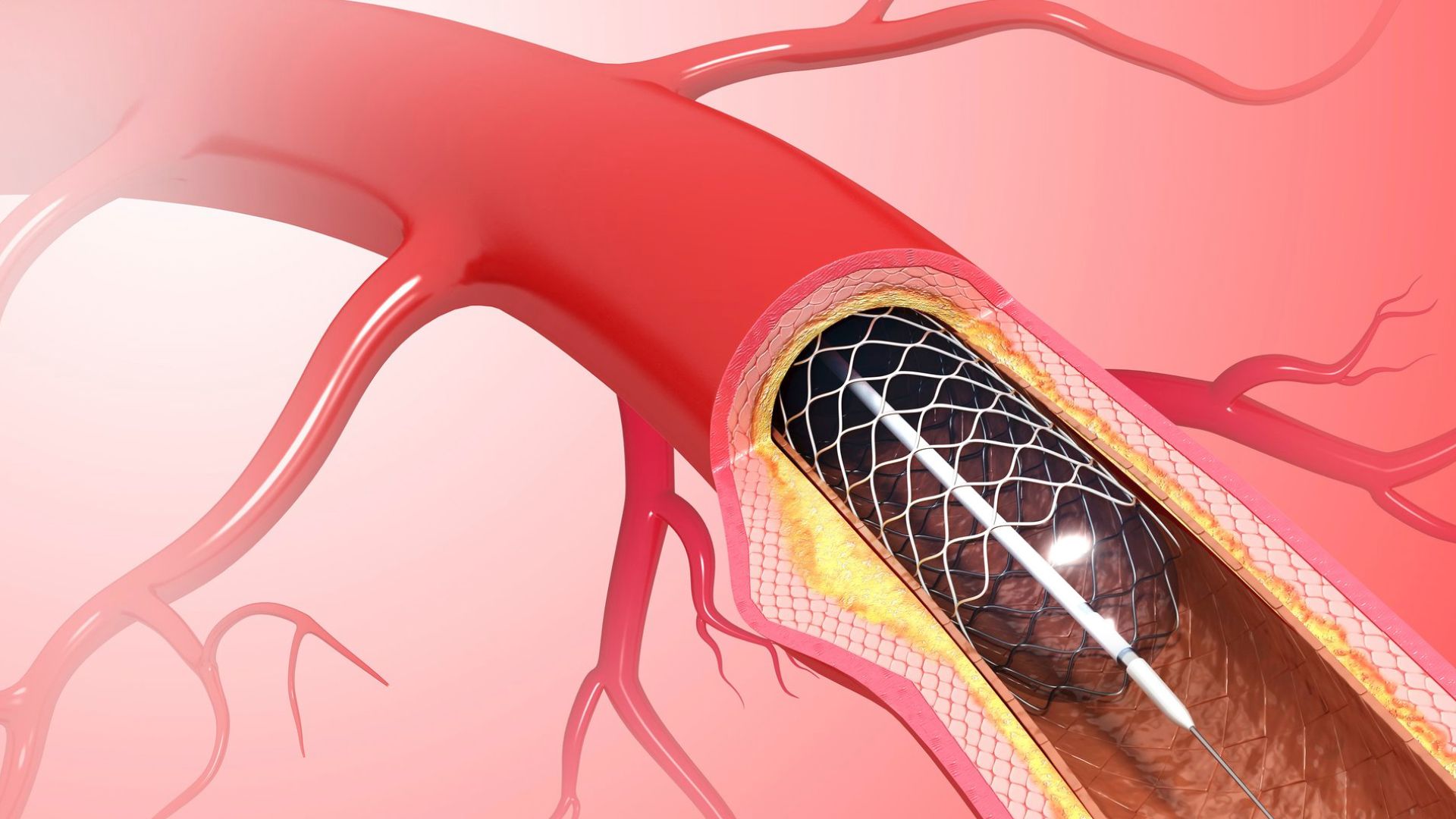 North America Balloon Catheter Market