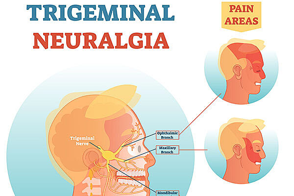 trigeminal neuralgia