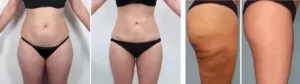 EXION Treatment in Clermont, FL