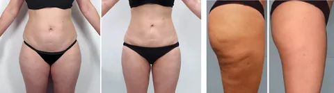 EXION Treatment in Clermont, FL