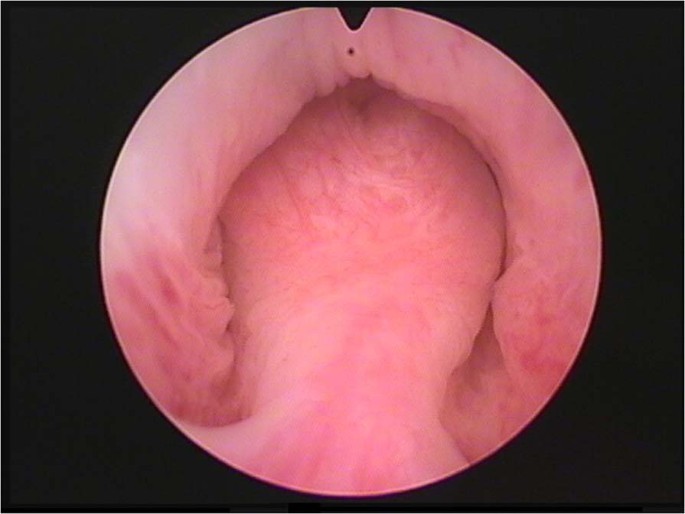 Prostatitis