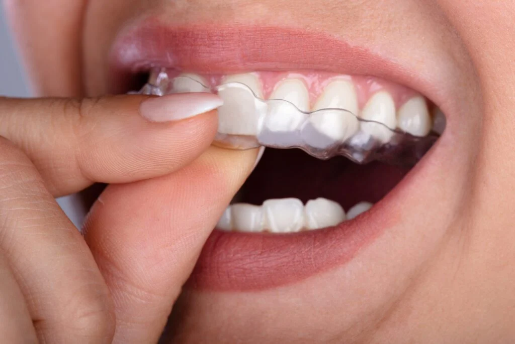 clear aligners austin tx