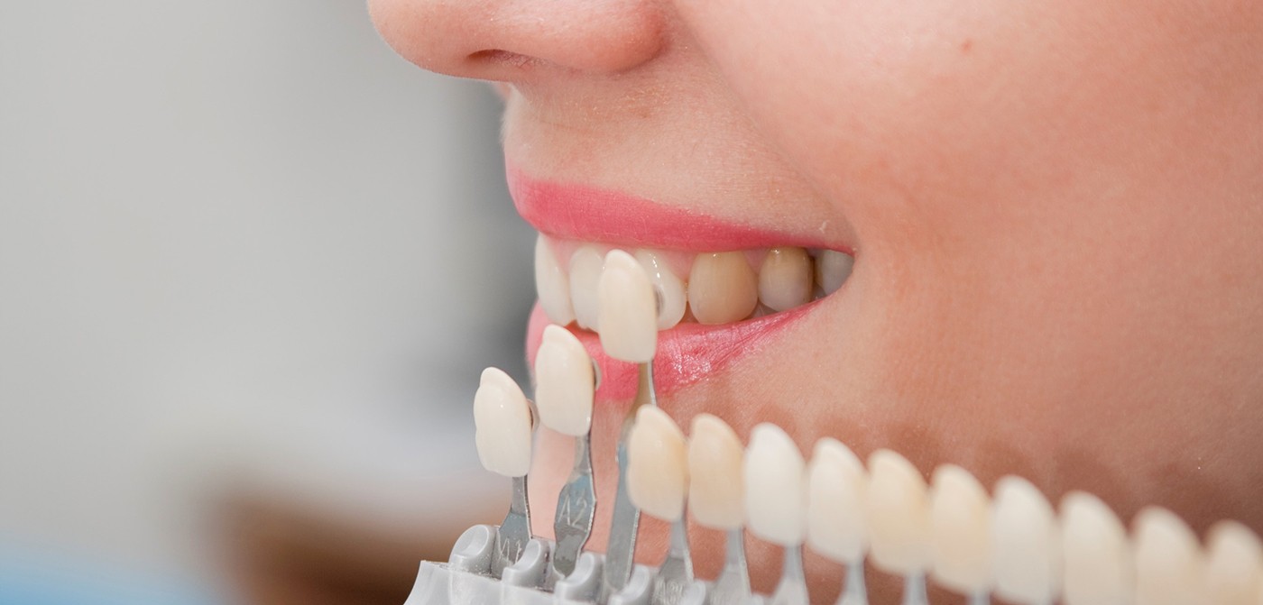 porcelain veneers crawfordville fl