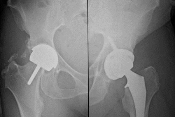 Hip Resurfacing vs. Hip Replacement: Which is Right for You?