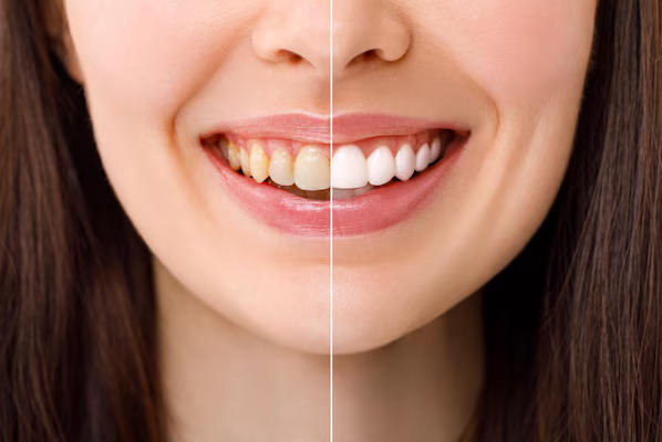 teeth whitening bowling green