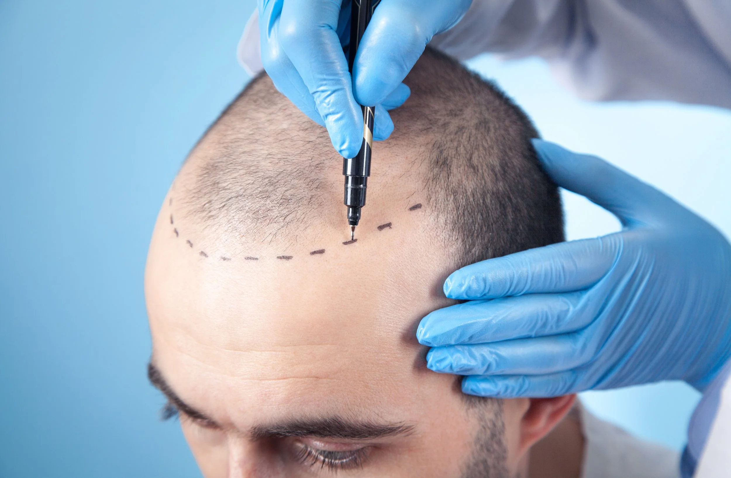 Hair Transplant in Dammam Saudi