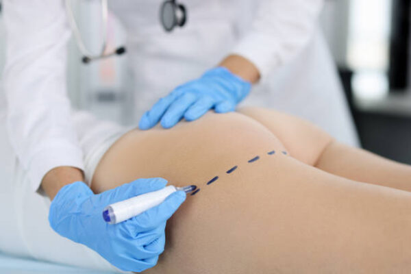 Liposuction in Riyadh