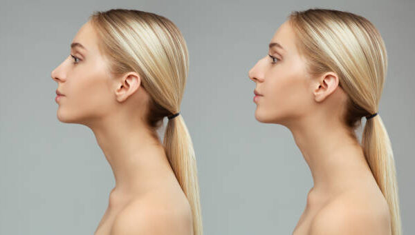 عملية تجميل الأنف في الرياض